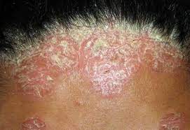 Lixeiramente exposto a lesións físicas. Psoriase Controle De Desordem Dermica Com Cosmeceuticos Adequados