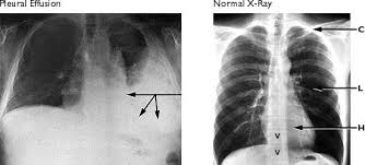 Pleural Effusion An Abnormal Chest X Ray Shows A Large Volume Of Fluid Arrows Inside The Pleural Sac Su Pleural Effusion Medical Knowledge Respiratory Care