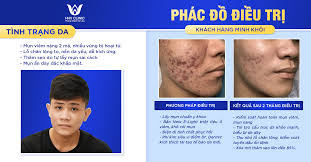 Review khách hàng điều trị mụn viêm tuổi dậy thì - Phòng Khám Da Liễu HHV  Clinic