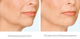 Here you may to know how to diminish marionette lines. Marionette Lines Jowls