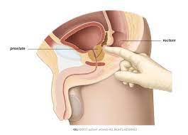 ··· medical advanced rectal touch examination simulator model: Digital Rectal Examination Patient Information