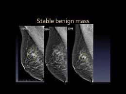 Image result for Mammogram Interpretation