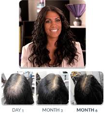 Patented Hair Regrowth System For Women Scalpmed Official