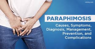 Image result for paraphimosis