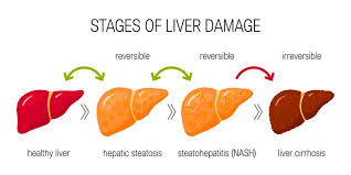 6 tips to reduce fatty liver disease common complication of