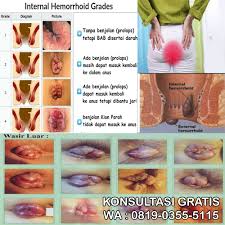 Mengalami gatal gatal karena alergi ??? Kumpulan Nama Obat Benjolan Anus Di Apotik Online Semarang Obat Anus Keluar Benjolan Dan Darah
