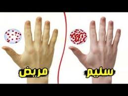 نعمة ربانية لعلاج فقر الدم الانيميا الحادة بدون دواء وزيادة مخزون الحديد peace gesture peace blog posts