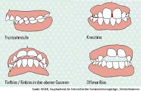 Wenn sie die lage der kiefer zueinander verändern sollen, kriegt man sie eher früher. Konsument At Zahnspange Auf Krankenkasse Brackets Von Der Kasse