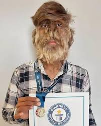 Image result for Hypertrichosis
