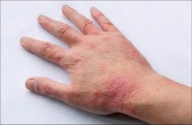 Image result for Atopic eczema atopic dermatitis