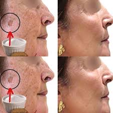 Baking soda erases age spots like an eraser