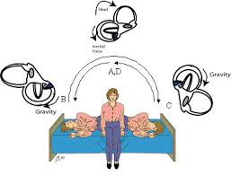 The said translation of signals is being done in a relative small and complex area behind the eardrum called the labyrinth or inner ear. Bppv Semont Maneuver
