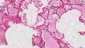 Maybe you would like to learn more about one of these? Histopathology Lung Pleura Mesothelioma Youtube