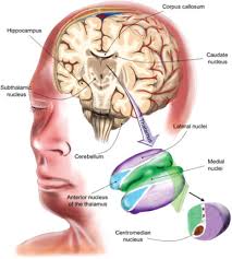 Image result for Thalamic Stimulation