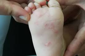Image result for scabies human children