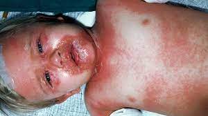 Scalded Skin Syndrome Causes Risk And Treatment