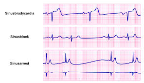Paroxysmal atrial flutter or fibrillation may also occur).2. Bradycardia Textbook Of Cardiology