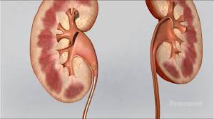 Kidney Stones Symptoms And Treatments Youtube