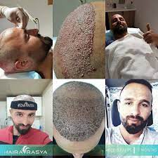 Hairavrasya Hairtransplant Sacekimi Trasplantecapilar Transplantacijakose زراعةالشعر Peresadkavolos Transplant In 2020 Hair Transplant Social Media Development