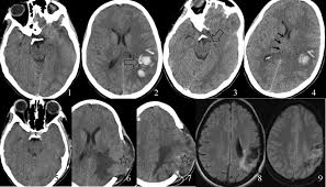 Can cerebral venous sinus thrombosis be prevented? Should Decompressive Surgery Be Performed In Malignant Cerebral Venous Thrombosis Stroke