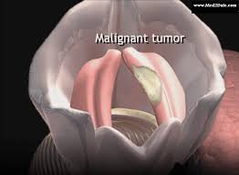 Oropharyngeal cancer is a type of head and neck cancer in which cancer cells are found within an area of your throat called your oropharynx. Cancer Larynx Causes Symptoms Stages Diagnosis Treatment