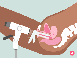 Image result for Colposcopy