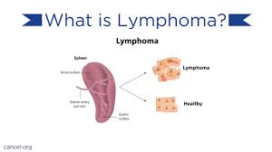 Lymphoma treatment can cause side effects. Lymphoma Causes And Treatments Youtube