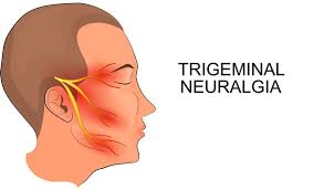 Trigeminus Neuralgie (TN) | gezondheid.be