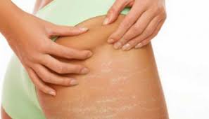 Garis tersebut bisa ada berikut 5 cara yang dirangkum liputan6.com untuk menghilangkan stretch mark yang dilansir dari. 5 Cara Menghilangkan Stretch Mark Tanpa Operasi Dan Laser Kesehatan Cantika Com