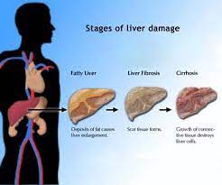Regimul alimentar în ciroza hepatică, fără ascită (lichid în burtă), fără icter (gălbinare): Regim Alimentar Ciroza