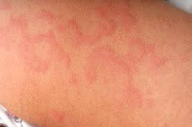 We did not find results for: La Urticaria Durante El Embarazo Asociacion Americana Del Embarazo
