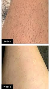 As technology improves, laser hair removal at home is likely to. Home Laser Hair Removal Reviews Cheaper Than Retail Price Buy Clothing Accessories And Lifestyle Products For Women Men