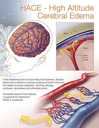 Image result for High Altitude Edema
