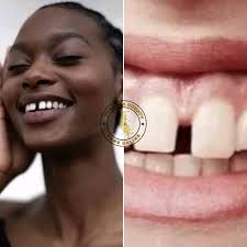 In my tribe, this gap in teeth is called ______