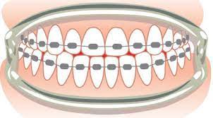 What you can use, both in home remedies and products, to stop the pain and be more comfortable in orthodontic. How To Make Your Braces Stop Hurting