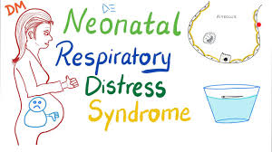 Neonatal Respiratory Distress Syndrome Nrds Youtube