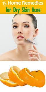 15 Effective Home Remedies For Dry Skin Acne How To Remove Pimples How To Get Rid Of Pimples How To Get Rid Of Acne