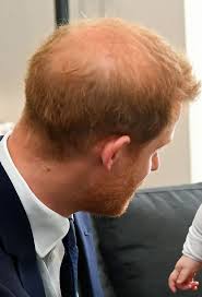 Prince Harry's hair loss is ...
