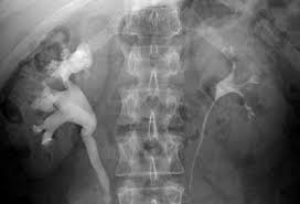 Image result for Nephrolithiasis Imaging