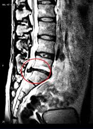 Image result for vyhřezlá ploténka