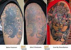 Is laser fading absolutely necessary prior to a cover up tattoo? 120 Tattoo Removal To Tattoo Cover Up Ideas In 2021 Laser Tattoo Removal Tattoo Cover Up Tattoo Removal