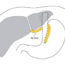 The ligamentum teres is divided and the falciform ligament freed from the abdominal wall and diaphragm. Teres Cardiopeksy The Round Ligament Of The Liver Carried Out For The Download Scientific Diagram