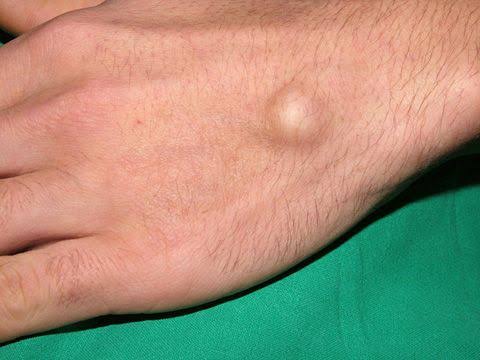 Hand Surgery Turkey - HAND TUMORS