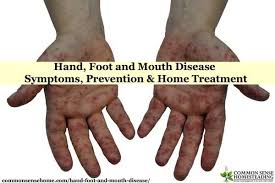Home Hand Foot And Mouth Health And Fitness Tips Disease