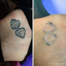 Book in for laser hair removal treatment and save 55% on courses of 8 plus, get free product pack worth £45. Results Of Tattoo Removal Procedures Clearstone Laser Hair Removal Medical Spa Clearstone Laser Hair Removal Medical Spa
