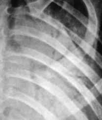 Image result for Air Bronchogram