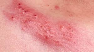 It also spreads to other parts of the body as the. Herpes Symptoms In Women What To Expect With Pictures
