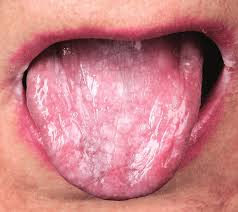 Image result for lichen planus on tongue)