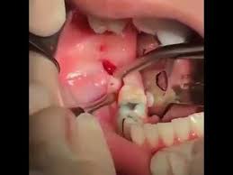 Dry socket also referred to as alveolar osteitis is one of the complications that usually occur after a permanent tooth tooth is extracted. Wisdom Tooth Extraction Removing An Impacted Mandibular Third Molar Video Wisdom Tooth Extraction Wisdom Teeth Wisdom Teeth Removal