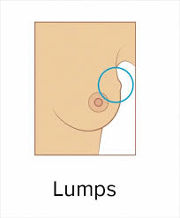 The most common symptom of breast cancer is a new lump or mass. These 9 Pics Show The Common Signs Of Breast Cancer Bored Panda
